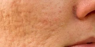 Cicatrici acneiche: cicatrici acne