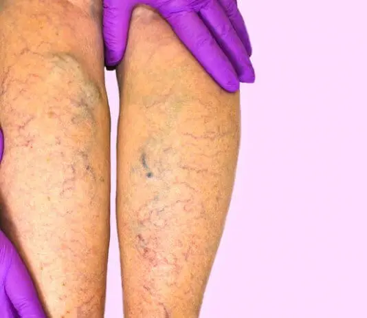 sclerosanti capillari gambe