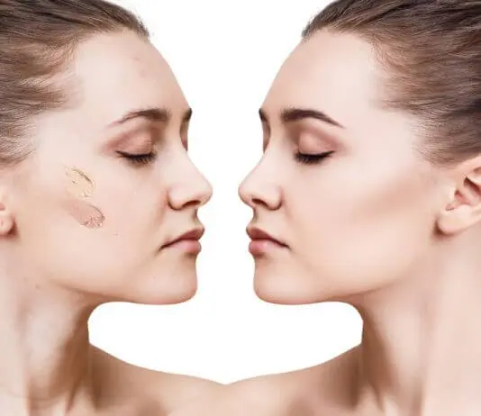 Come coprire i brufoli? come coprire i brufoli con il trucco