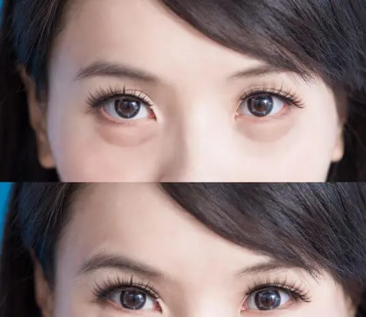 Occhi gonfi al mattino? Quali sono i rimedi che funzionano? occhi gonfi al mattino cause