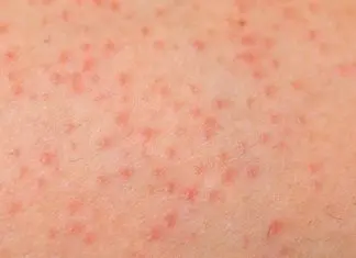 macchie rosse sulla pelle senza prurito