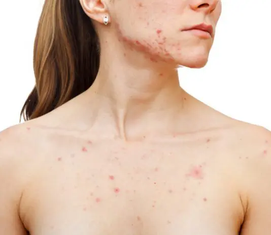 Brufoli dolorosi, brufoli che fanno male: cosa puoi fare! brufoli dolorosi sottopelle