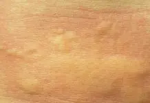 Macchie rosse sul corpo da cosa dipendono e quando preoccuparsi! macchie rosse sul corpo rimedi