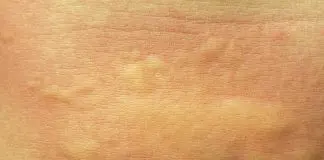 macchie rosse sul corpo rimedi