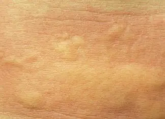 macchie rosse sul corpo rimedi