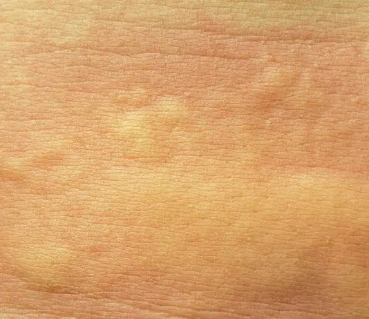 macchie rosse sul corpo rimedi