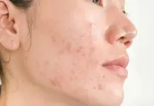 acne comedonica cura