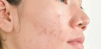 acne comedonica cura