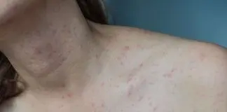 psoriasi inversa cura