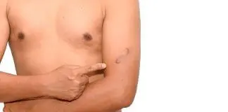 CHELOIDE E CHELOIDI