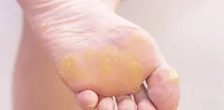 verruche plantari e verruche piedi