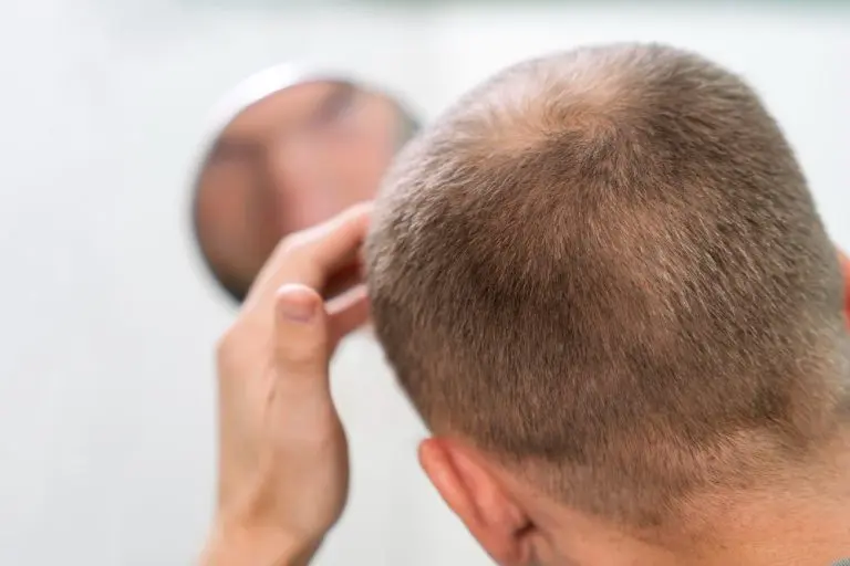 Migliori Integratori per Capelli: Confronto Locerin Profolan e Folisin