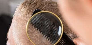 Caduta capelli uomo: diradamento capelli
