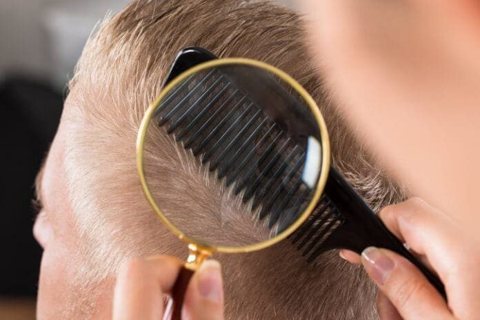 Caduta capelli uomo: diradamento capelli