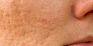 Cicatrici acneiche: cicatrici acne