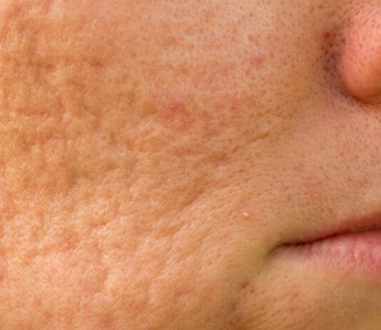 Cicatrici acneiche: cicatrici acne