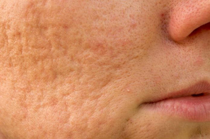 Cicatrici acneiche: cicatrici acne