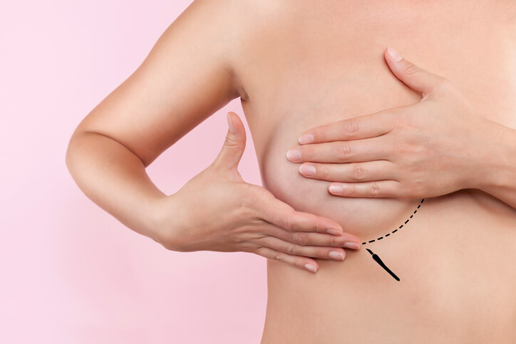 Rifare il seno:mastoplastica additiva prezzi