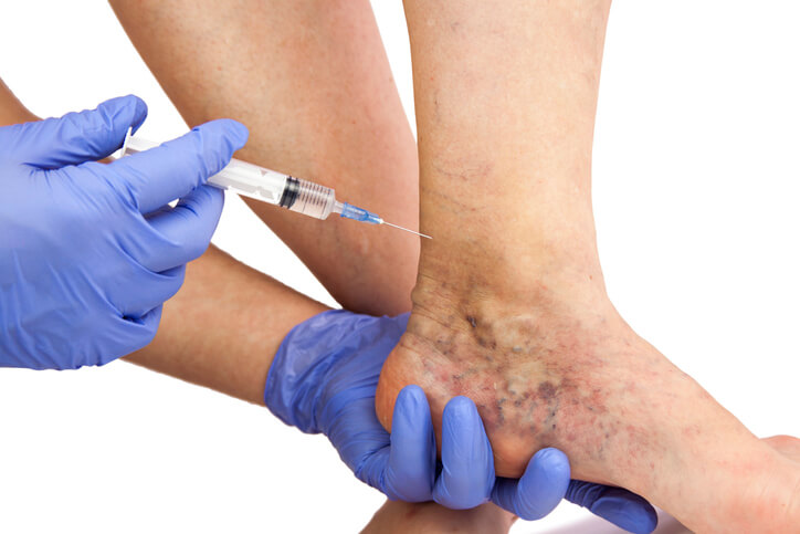 sclerosanti: eliminare capillari gambe