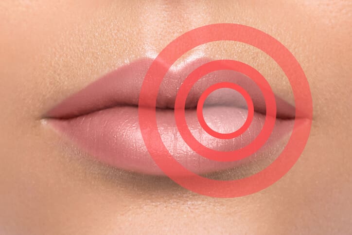 papilloma virus sulle labbra della bocca