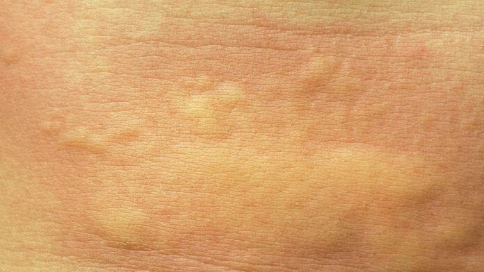 macchie rosse sul corpo rimedi