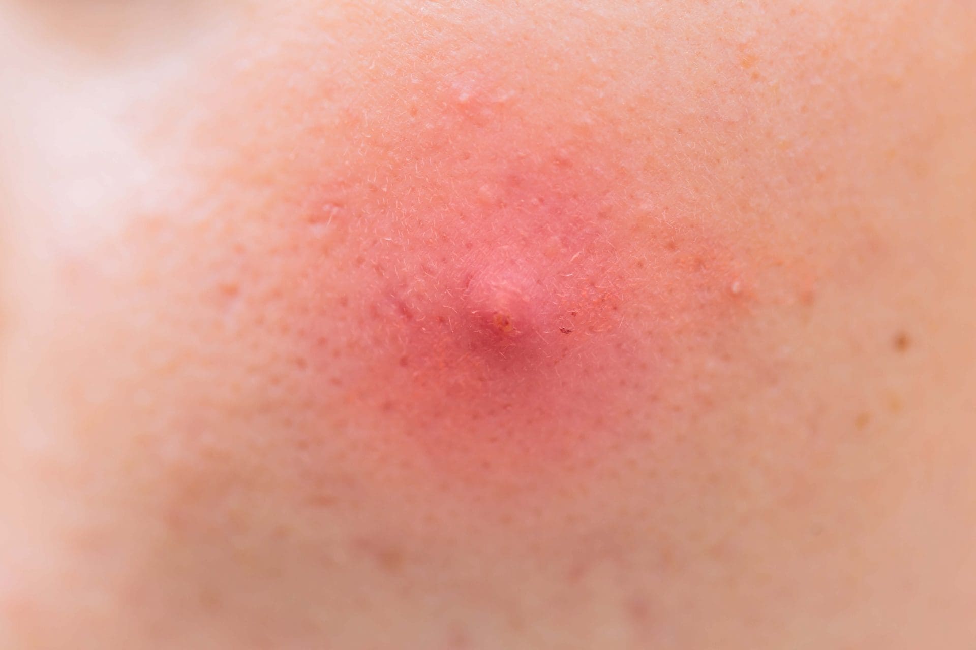 rimedi naturali pelle irritata