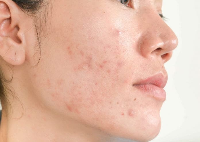 acne comedonica cura