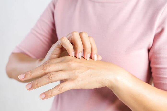 psoriasi mani